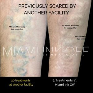 before & after tattoo removal Miami Ink Off 0017