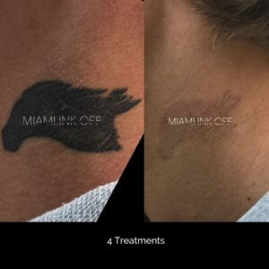 before & after tattoo removal Miami Ink Off 0009
