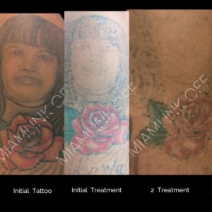before & after tattoo removal Miami Ink Off 0019