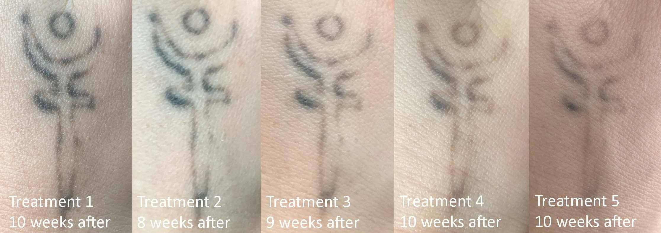 A Before and After image of a tattoo being partially removed using the PicoWay tattoo removal laser
